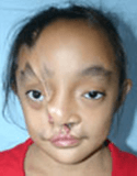Cleft Lip and Palate – Cleft NZ – Cleft Lip Operation Restore Hope