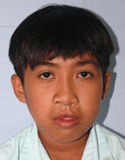 Cleft Lip and Palate – Cleft NZ – Cleft Lip Operation Restore Hope