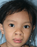 Cleft Lip and Palate – Cleft NZ – Cleft Lip Operation Restore Hope