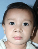 Cleft Lip and Palate – Cleft NZ – Cleft Lip Operation Restore Hope