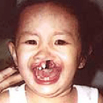 Cleft Lip and Palate – Cleft NZ – Cleft Lip Operation Restore Hope