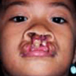 Cleft Lip and Palate – Cleft NZ – Cleft Lip Operation Restore Hope