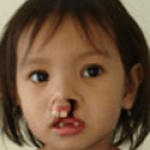 Cleft Lip and Palate – Cleft NZ – Cleft Lip Operation Restore Hope