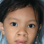 Cleft Lip and Palate – Cleft NZ – Cleft Lip Operation Restore Hope