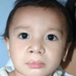 Cleft Lip and Palate – Cleft NZ – Cleft Lip Operation Restore Hope