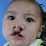 Cleft Lip and Palate – Cleft NZ – Cleft Lip Operation Restore Hope