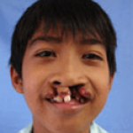 Cleft Lip and Palate – Cleft NZ – Cleft Lip Operation Restore Hope