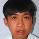 Cleft Lip and Palate – Cleft NZ – Cleft Lip Operation Restore Hope